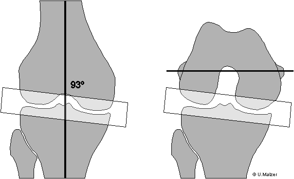 Component Alignment German